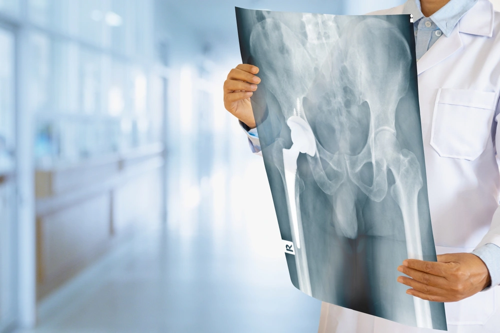 Hip Replacement Surgery Cost in India